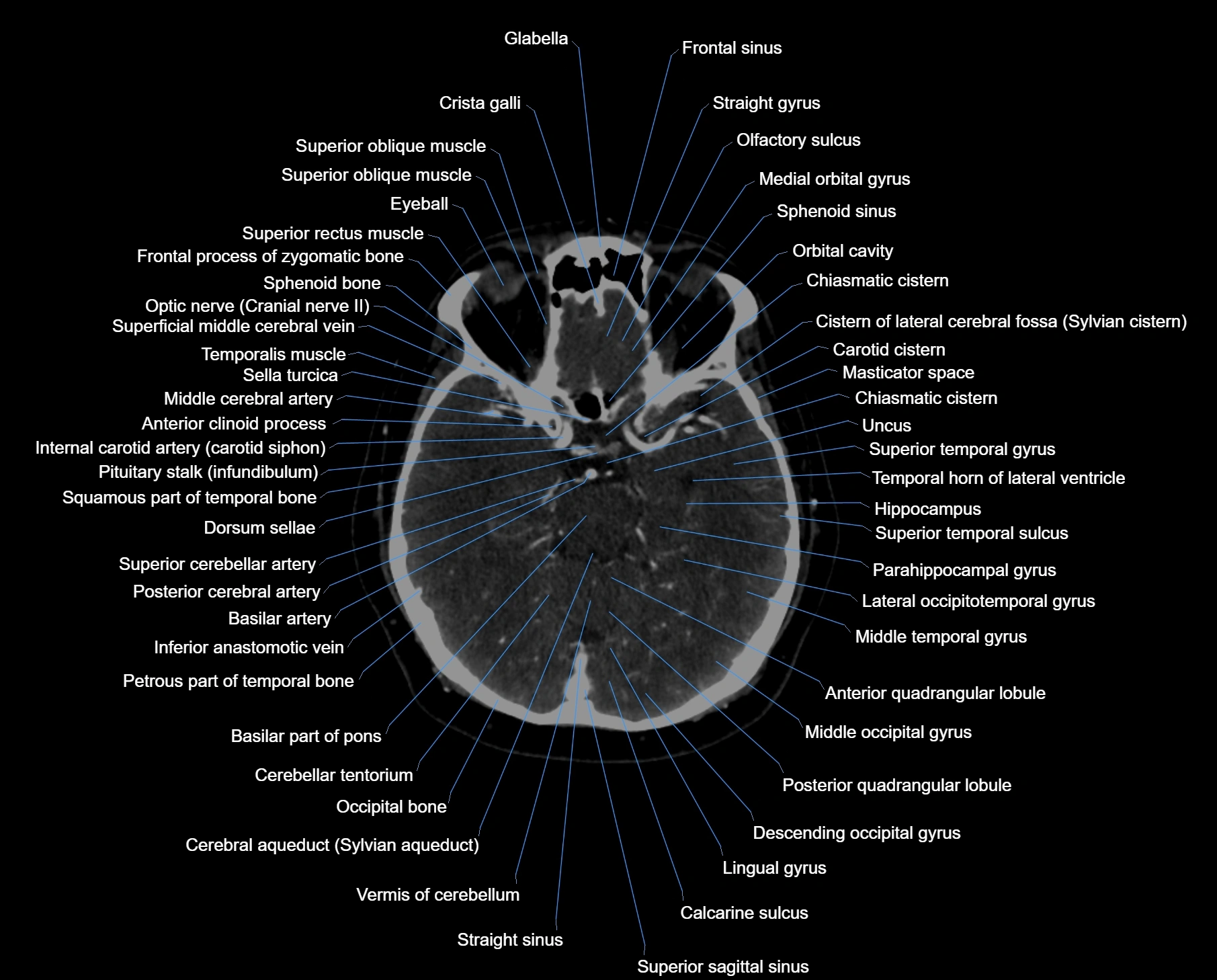 CT scan brain axial labelled cross sectional anatomy image-img-000026.webp
